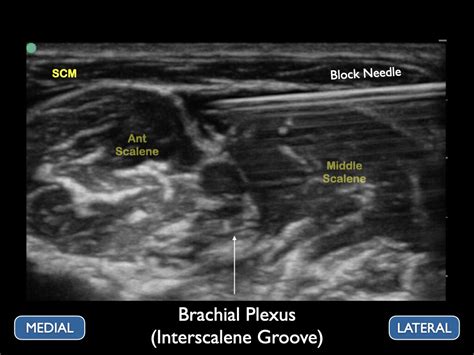 Interscalene Highland Em Ultrasound Fueled Pain Management