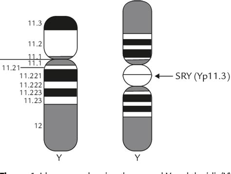 Figure 1 From Delineation Of An Isodicentric Y Chromosome In A Mosaic 45x46xidicyqter P11