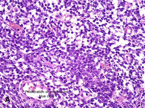 American Urological Association Rhabdomyosarcoma