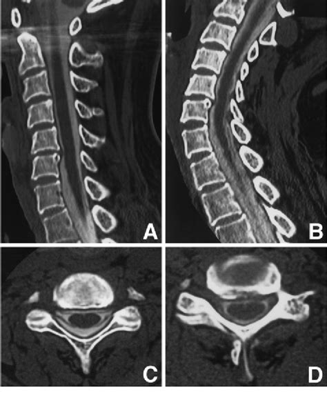 Case 8 Series Of Sagittal A B And Axial Images C D Of Dynamic Download Scientific