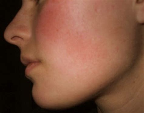 Rash On Face Treatment Causes Pictures Hubpages