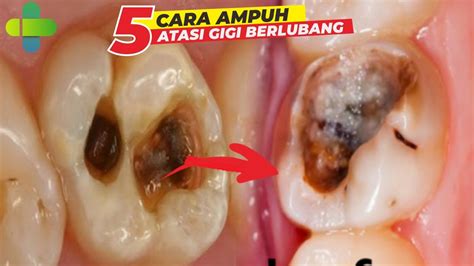 5 Cara Atasi Sakit Gigi Berlubang Paling Ampuh Dan Tidak Kambuh Lagi Ll