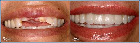 Dental Implants Before and Afters - Southland dental Care