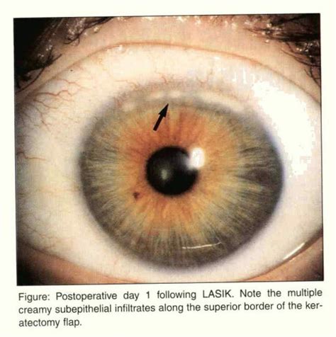 Marginal Keratitis