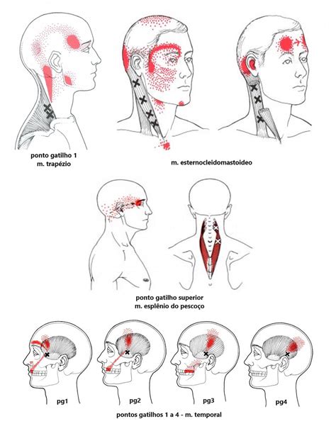 Pontos Gatilhos Miofasciais Cefaleia