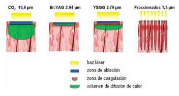 L Ser Luz Pulsada Radiofrecuencia Y Otras Fuentes De Energ A