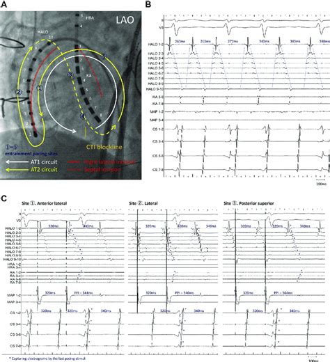 Fluoroscopic Image And Intracardiac Electrograms A B Fluoroscopic