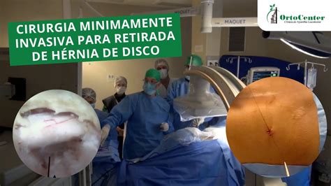 Cirurgia Minimamente Invasiva Para Retirada De H Rnia De Disco