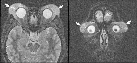 Cranial Magnetic Resonance Imaging Mri Revealed Bilateral Lacrimal