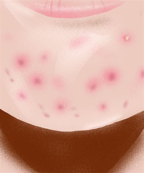 Small Red Spots On Belly
