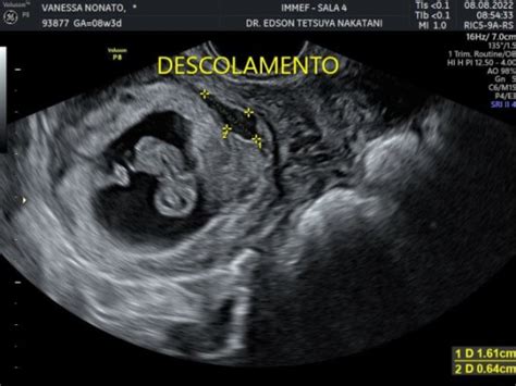 Descolamento De Placenta Babycenter