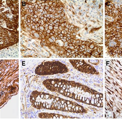 Immunohistochemical Staining For β Catenin Expression In 18 Download Scientific Diagram