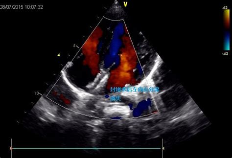 教你读心脏彩超之房间隔缺损 知乎