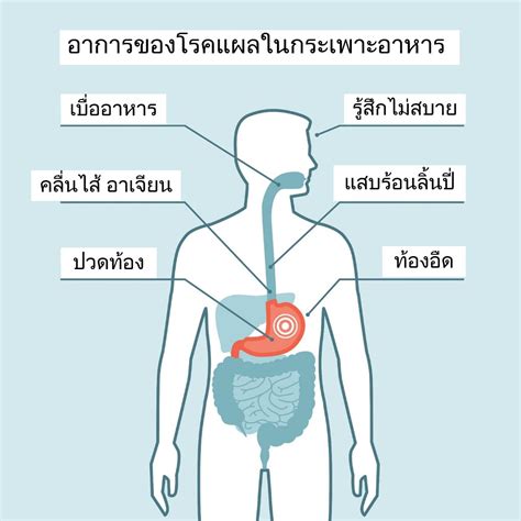 แผลในกระเพาะอาหาร และการปฏิบัติตัว แพทย์ทางเลือก