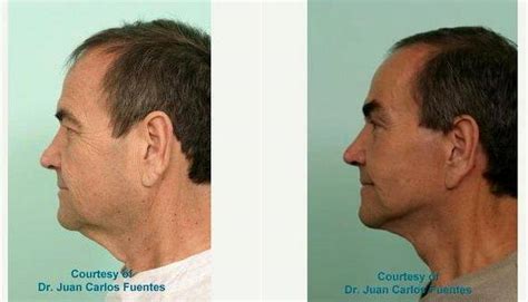 Dr Juan Carlos Fuentes Md Mexico Plastic Surgeon Facelift And