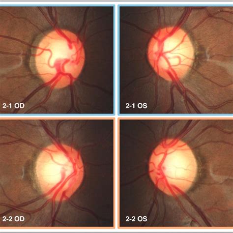 PDF Optic Nerve Head Anatomy In Myopia And Glaucoma Including