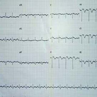 ECG Showed Sinus Tachycardia With Old Antero Lateral Infraction