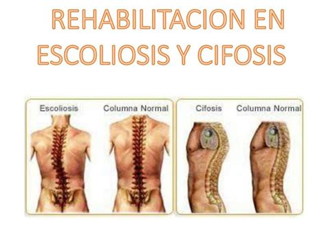 Rehabilitación en Escoliosis y Cifosis Mishelle Ch uDocz