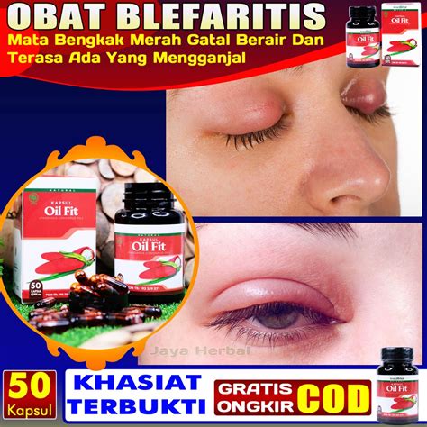 Jual Obat Blefaritis Radang Kelopak Mata Bengkak Merah Gatal Berair