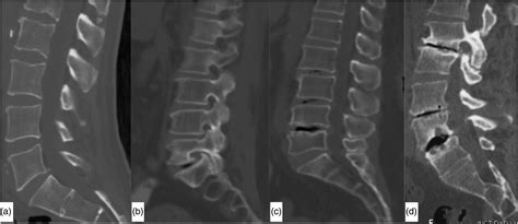 Vacuum Disc Phenomenon Mri at lukegfarmer blog