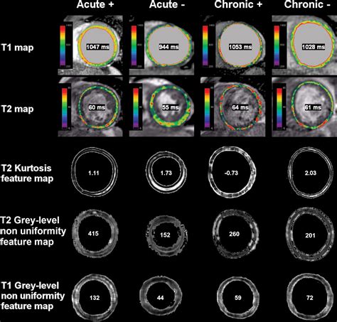 Cardiac Mri And Texture Analysis Of Myocardial T And T Maps In