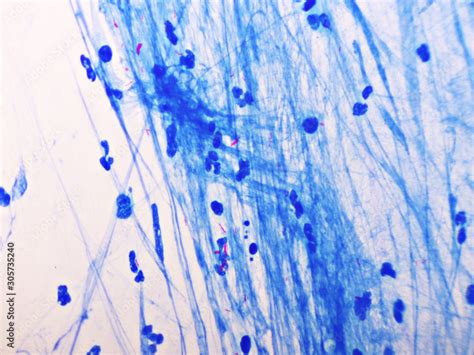 Foto De Mycobacterium Tuberculosis Positive Small Red Rod In Sputum Smear Acid Fast Stain