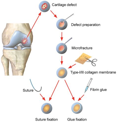 Autologous Matrix Induced Chondrogenesis A Systematic Review Of The