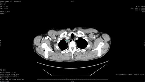 The axial CT scan a solid nodular-like expansive process in the right... | Download Scientific ...