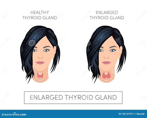 Female With Normal And Enlarged Thyroid Gland Stock Illustration Illustration Of Human