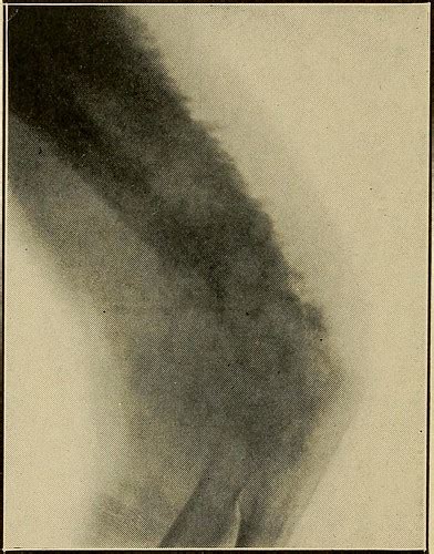 Capillary Punc Eq Procd Ch Flashcards Quizlet