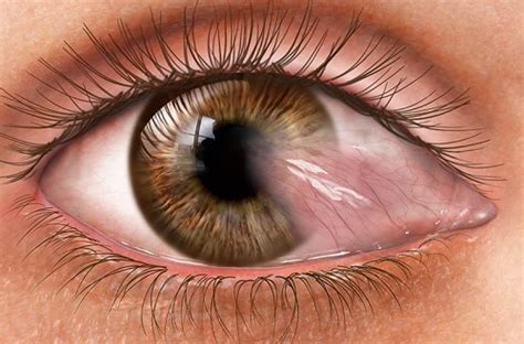 Pterygium Surgery Central Maryland Eye Associates Frederick