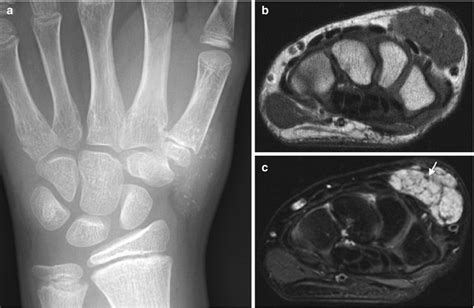 Soft Tissue Masses Radiology Key