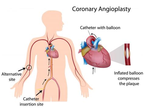 What Is Angioplasty With Pictures