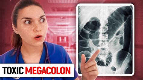 Toxic Megacolon Day In The Life Of A Doctor Medpage Today