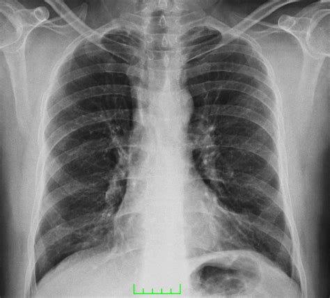 Lung Involvement in Brucellosis - MedCrave online