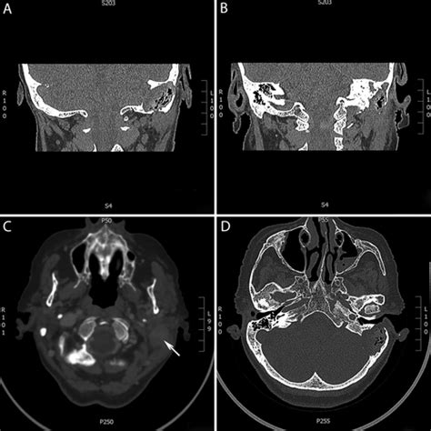 External Auditory Canal Cholesteatoma Causing Simultaneous Bezold