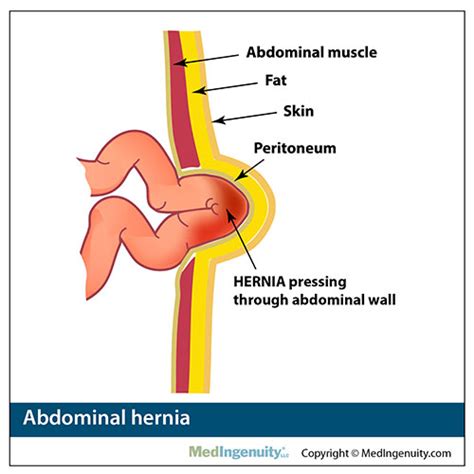 Hernia pictures: A visual guide to different hernia types, femoral ...