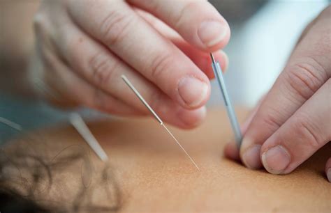 Dry Needling Vs Acupuncture Understanding The Differences And Benefits