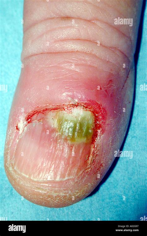 Paronychia Infection Around Fingernail Stock Photo Alamy