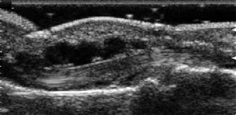 Longitudinal scan of the 2 nd finger. Dactylitis due to the flexor ...