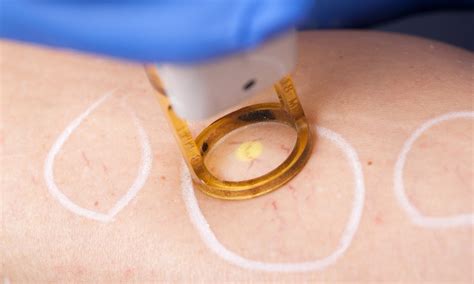 Laser Treatment For Varicose Veins Everything You Need To Know