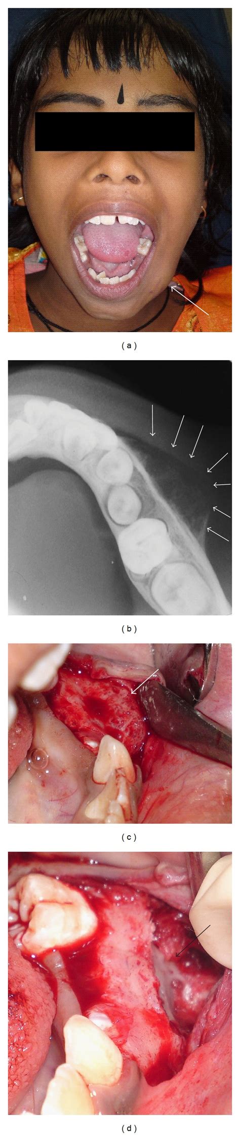 A Swelling Of The Mandible Of 2 Month Duration B Mandibular Download Scientific Diagram