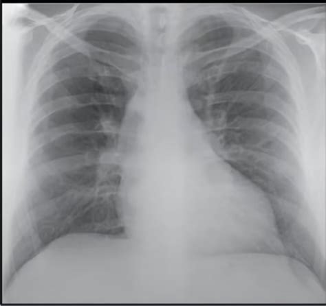 Clin Med Pulmonology Flashcards Quizlet