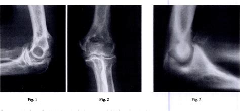 Figure 1 From Primary Degenerative Arthritis Of The Elbow Treatment By Ulnohumeral Arthroplasty