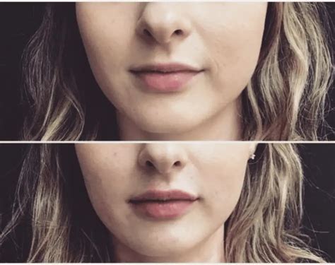 Smile Line Fillers Before And After Adult And Pediatric Dermatology