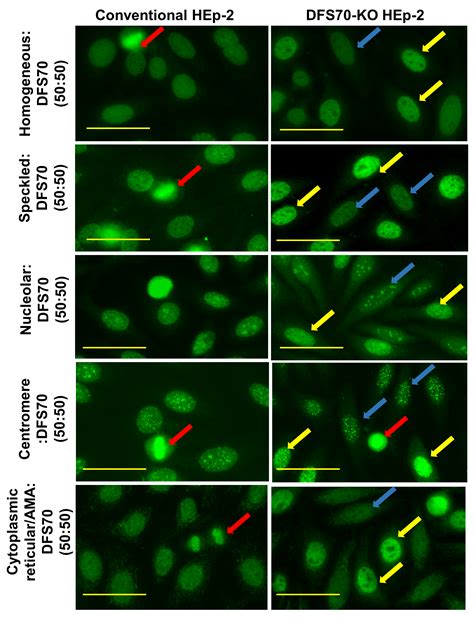 Simultaneous Distinction Of Monospecific And Mixed Dfs70 Patterns