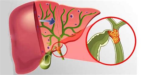 Cáncer de las Vías Biliares oncologomonterrey