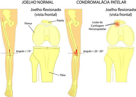 O Que é O Condromalácia Patelar Dr Denys Aragão