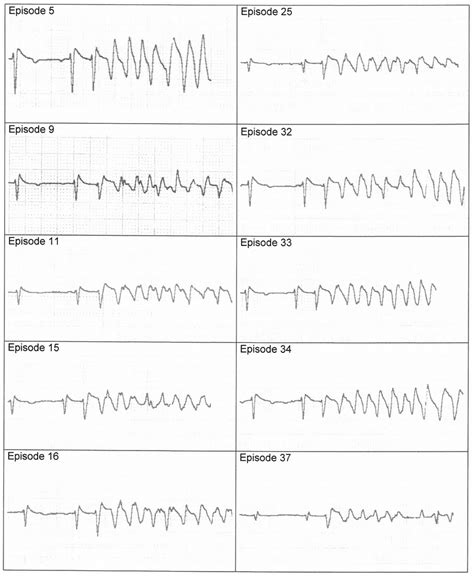 Onset Of The Arrhythmias Download Scientific Diagram