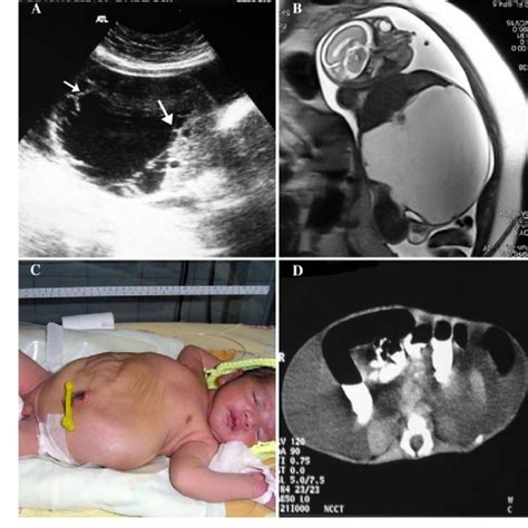 A 26 Week Fetus With Chylous Ascitis A Axial Grayscale Sonogram Shows